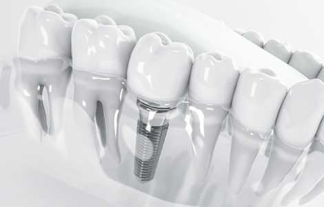 インプラント治療